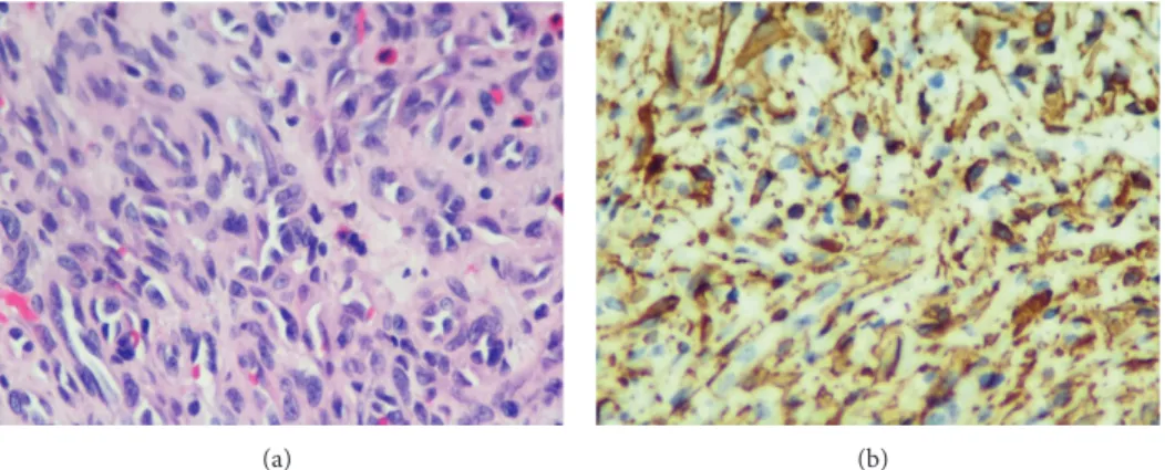 Figure 3: (a) Thin-walled vessels with a concentric, perivascular gathering of spindled myoid tumor cells (HE-Stain, ×40)