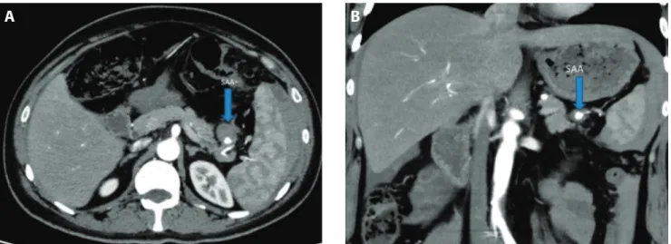 Figure 1 A-B. Axial (A) and coronal (B) contrast-enhanced CT images reveal a partially thrombosed pseudoaneurysm in the distal segment of the splenic artery.