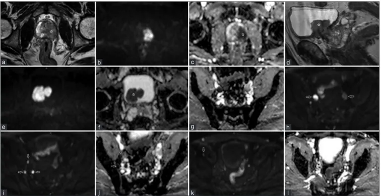 Figure 1: In transaxial images lesion located at the left side of the central zone was hypointense in T2A (a) and apparent diffusion coefficient  (c), while hyperintense in diffuse weighted imaging (b)