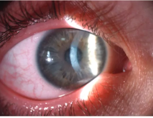 Figure 4: Biomicroscopy of cornea at the end of first month revealing complete resolution of keratitis.