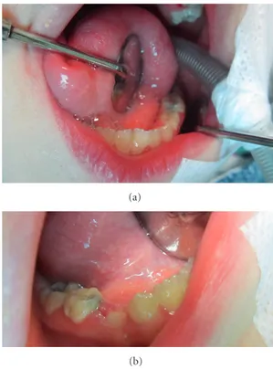 Figure 4: Talon cusps were present on maxillary central and lateral incisors.
