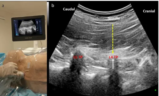 Figure 1 a, b. a) Probe and ultrasound setup for the ESP block. b) Sonographic image of the L-ESP block