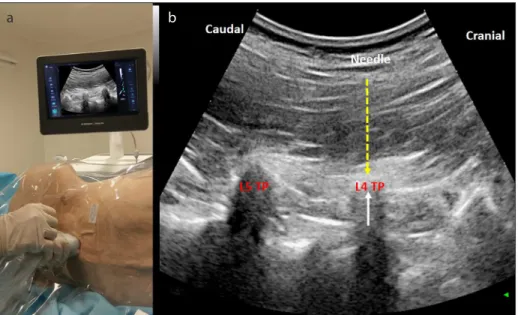 Figure 1 a, b. a) Probe and ultrasound setup for the ESP block. b) Sonographic image of the L-ESP block