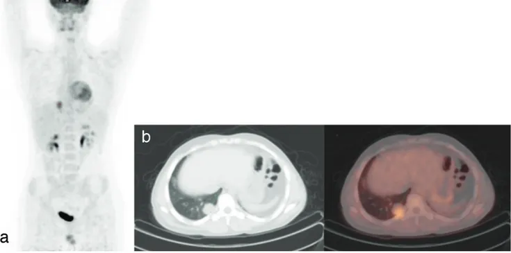 Figure 2.  MIP  (a),  transaxial  CT  (b),  and  fusion  18 F-FDG  PET/CT  images  of  a  16-year-old  male  patient