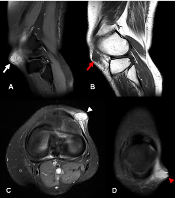 Figure 1. MRI of the left knee. A - Sagittal fat-sat T2-weighted image that demonstrates a 2-cm hyperintense  cystic lesion in the subcutaneous fat tissue close to the outer part of the lateral retinaculum (white arrow); 