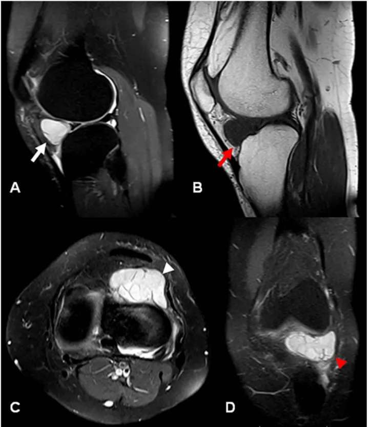 Figure 4. MRI of the left knee. A - Sagittal fat-sat T2-weighted image demonstrates a 3.5 × 2 cm hyperintense  cystic lesion in the infrapatellar fossa compatible with ganglion cyst (white arrow); B - Sagittal T1-weighted image  showing homogeneous hypoint