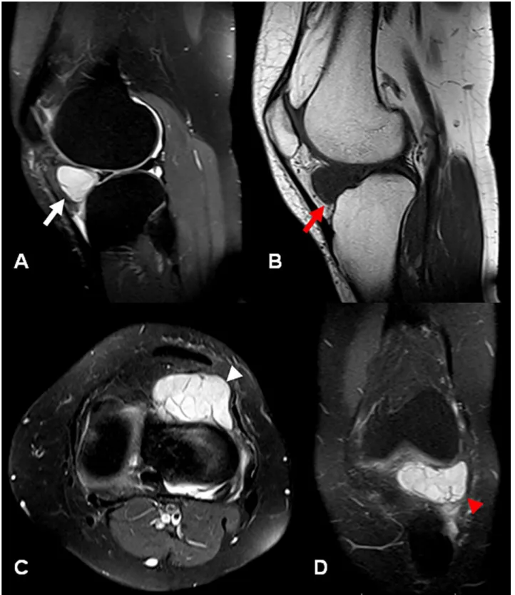 Figure 4. MRI of the left knee. A - Sagittal fat-sat T2-weighted image demonstrates a 3.5 × 2 cm hyperintense  cystic lesion in the infrapatellar fossa compatible with ganglion cyst (white arrow); B - Sagittal T1-weighted image  showing homogeneous hypoint