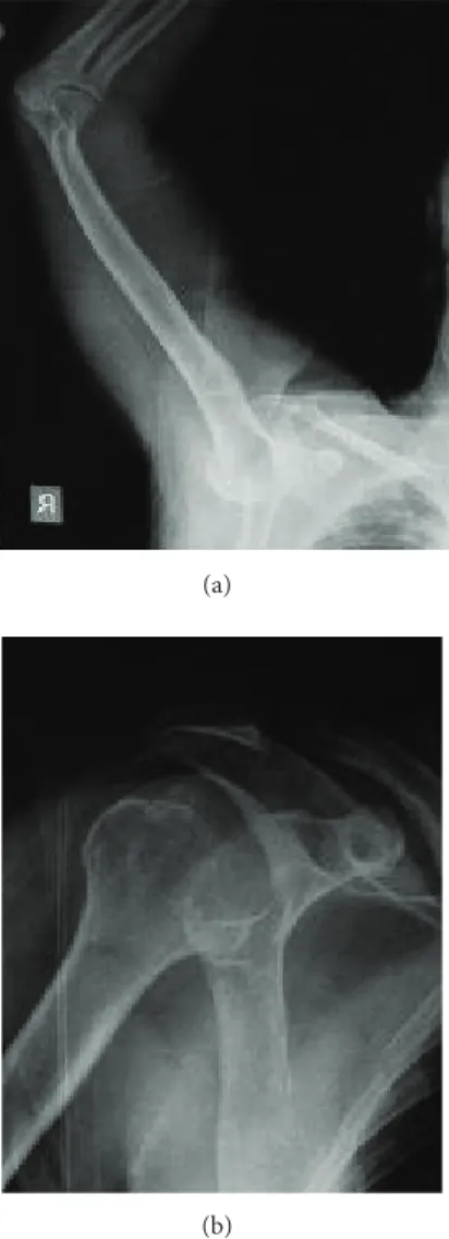 Figure 2: X-ray of the humeral head located below the rim of glenoid and X-ray after the reduction was achieved.