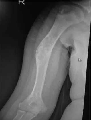 Figure 1. Preoperative AP view of simple bone cyst. Figure 2. Postoperative 6 th  month AP view of the simple bone  cyst of the same patient.