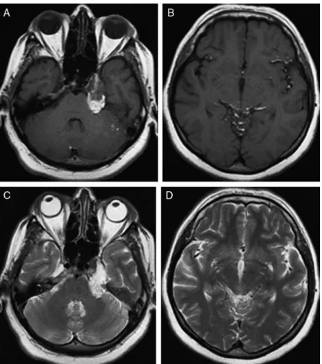 FIGURE 2. Disseminated hyperintense areas, suggesting a hyperintense dermoid cyst that extends from the left cerebellopontine cistern, adjacent to the left carotid channel, to the cavernous sinus (A and C), and rupture at the subarachnoid range including t