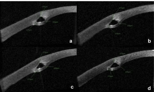 Figure 1. The AS-OCT images of a representative case at postoperative visits (A: at 6 months B: at 1-year C: at 3-years D: at 5-years).