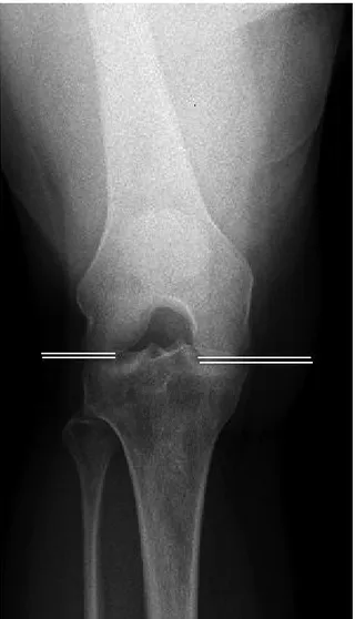 Şekil 2. Rozenberg grafisinde diz eklemi medial ve lateral ara- ara-lıkları ölçümü.