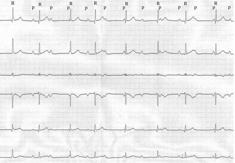 FIG. 1. Electrocardiogram showing complete atrioventricular block P: P wave; R: R wave