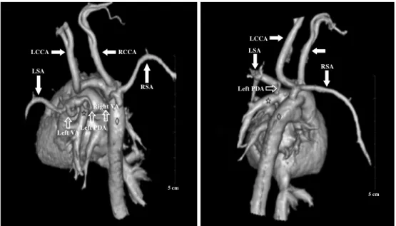 Figure 1. Computed tomography angiography showing an isolated origin of LSA from LPA via a  left-sided PDA