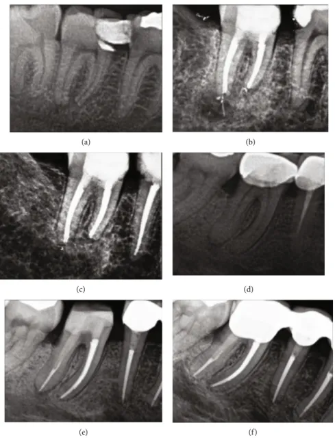 Figure 1: Radiographic evaluation of diﬀerent teeth before and after the treatment: (a) right mandibular second molar tooth, preoperative radiograph; (b) right mandibular second molar tooth, after the treatment; (c) right mandibular second molar tooth, a 6