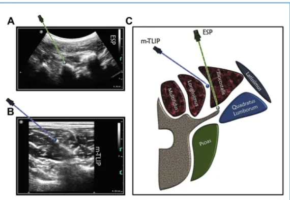 Figure 2. This image shows the real-time sonographic and classic anatomy of the erector spinae plane (ESP) and modified-thoracolumbar interfascial plane (mTLIP) blocks
