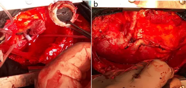 Fig. 3 – Reoperation view with peripheral cardiopulmonary bypass. A) Mitral replacement for disfunctional  mitral prosthesis; B) vein graft exposure for coronary artery bypass.