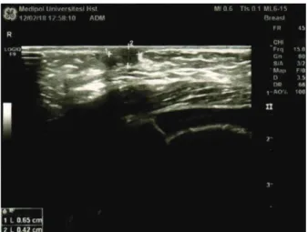 Figure 1: Breast ultrasonography of the case 1 showing  retroareolar dilated ducts