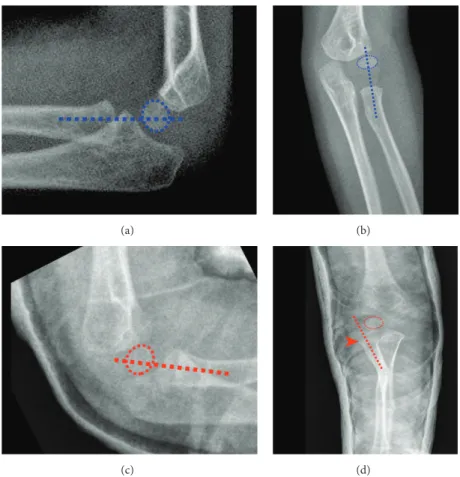 Figure 2: AP (a) and lateral (b) views of the healthy side with radiocapitellar lines