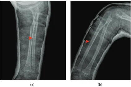 Figure 3: Anatomic reduction of the ulnar fracture in AP (a) and lateral (b) views. Arrow heads show hardly recognizable ulnar fracture lines.