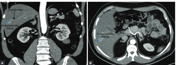 Figs 1A and B: Coronal (A) and axial (B) CTA images reveal an aneurysmatic fistula (blue arrow) approximately 2 cm in size in the  intersection of segment 5 to 6 of the right lobe, between the right portal vein (black arrow) and the right hepatic vein bran