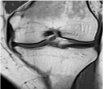 Figure 2. Coronal T1-weighted MRI of the knee in a 56-year- 56-year-old  nonsmoker  woman  with  grade  4  bone  marrow  reconversion