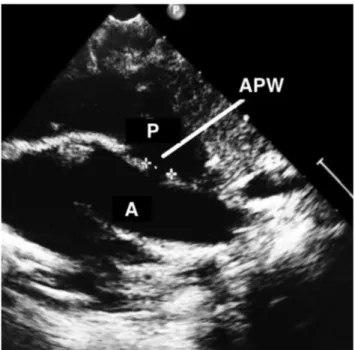 Figure 1.  An  echocardiographic  view  showing  aorta  and  pulmonary artery and centrally located aortopulmonary window.
