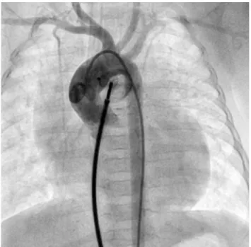 Figure 2.  Control  aortography  before  device  releasing.  The  device position is correct, and no residual shunt and protrusion  into vessels are seen.
