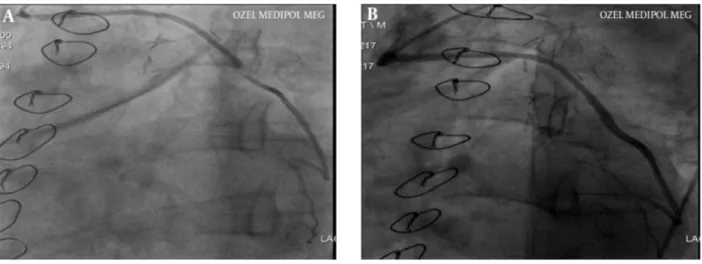 Figure 1. A, Angiographic View of the Saphenous Vein Graft Lesions at the Ostial and Mid Portion; B, Successful Stenting of the Saphenous Graft Lesions