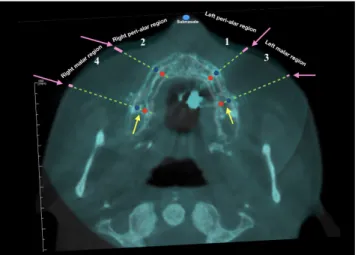 Figure 2. Superimposition of pre-expansion and post-expansion  cone-beam computed tomography  images