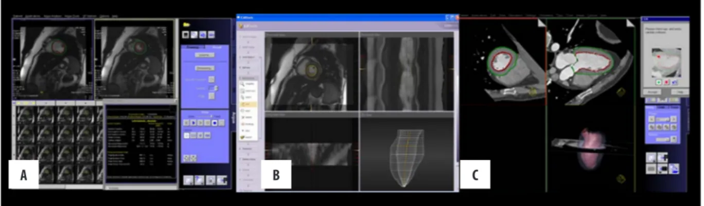 Figure 1.  Left ventricular analysis with (A) MR Argus, (B) CMR tools, and (C) MDCT.