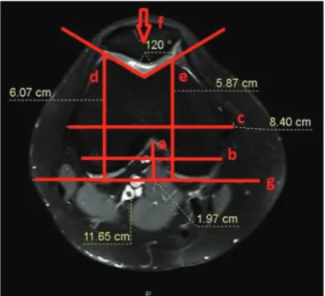 Figure 1: Axial magnetic resonance image of distal femur. a: NH, b: NW,  c: FML, d: FLAP, e: FMAP, f: TGA, g: Reference line