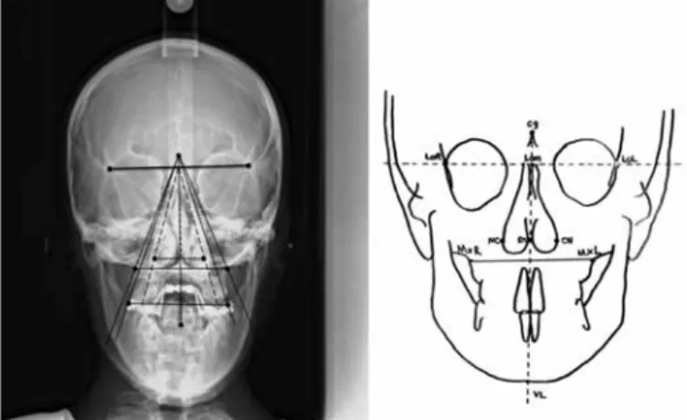 Figure 2. Measurement of orthodontic points on posteroanterior ceph- ceph-alogram (left) and illustration (right).