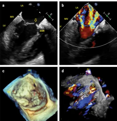 Figure 1. (a) Transesophageal echocardiography, mid-esophageal long- long-axis view. The yellow arrow indicates the perforation in the anterior  mitral leaflet