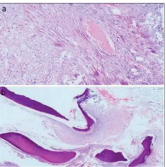 FIGURE 3: Histological examination shows endobronchial hamartoma: a) fib- fib-roblast cell mesenchymal proliferation and vascular structure (hematoxylin and eosin, x100)