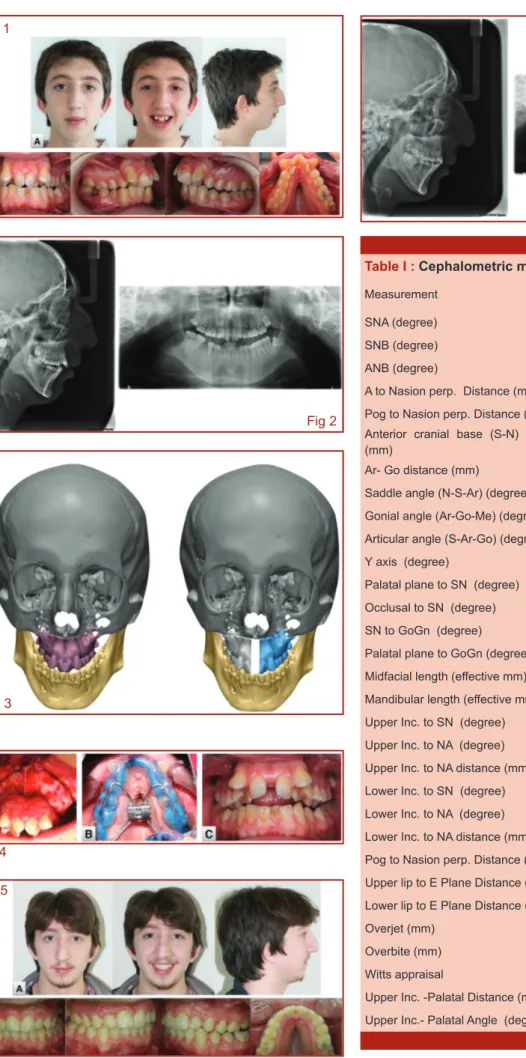 Table I : Cephalometric measurements