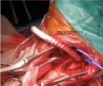 Figure 2: External crossover bypass between external carotid arteries.