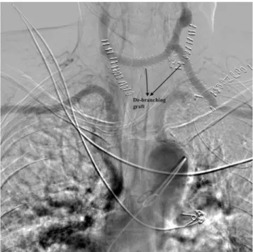 Figure 3: Control angiography of the debranching procedure during thoracic endovascular aortic repair.