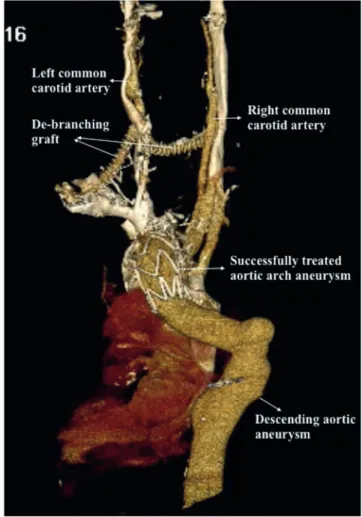 Figure 7: Computed angiography showing a descending aortic aneurysm that was 5.5 cm at the largest diameter.
