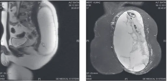 Figure 2a and b – Huge post-traumatic cyst MR findings (sagittal and coronal).