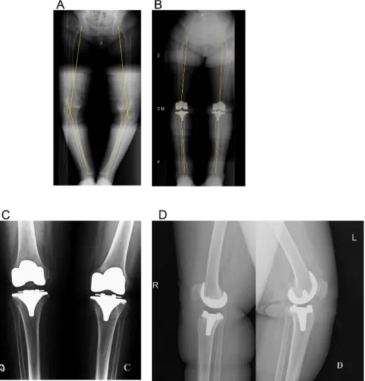 Fig. 1. A 68-year-old woman with bilateral osteoarthritis of knee with severe varus deformity
