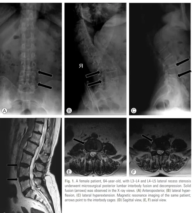 Fig. 1. A female patient, 64-year-old, with L3–L4 and L4–L5 lateral recess stenosis  underwent microsurgical posterior lumbar interbody fusion and decompression