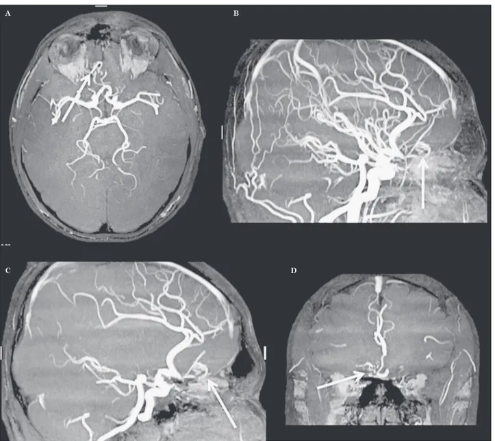 Figure 3  TOF MRA. Abnormal arterial branches (arrows) originating from the anterior cerebral artery in axial (A), sagittal (B,C),  coronal (D) images.