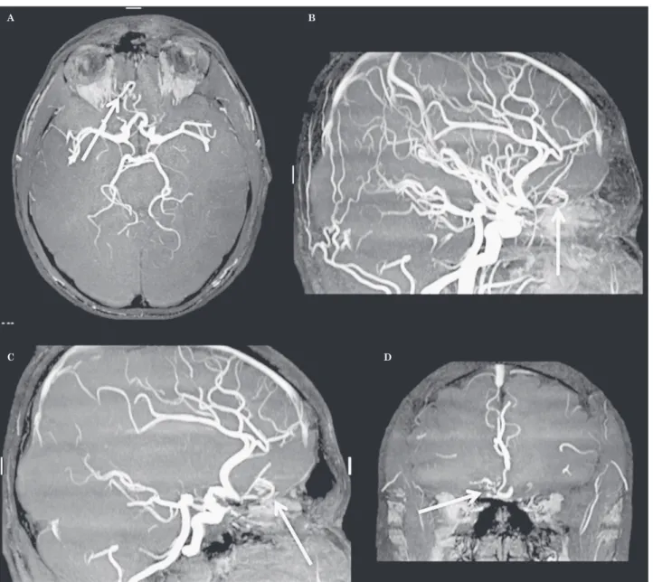 Figure 3  TOF MRA. Abnormal arterial branches (arrows) originating from the anterior cerebral artery in axial (A), sagittal (B,C),  coronal (D) images.