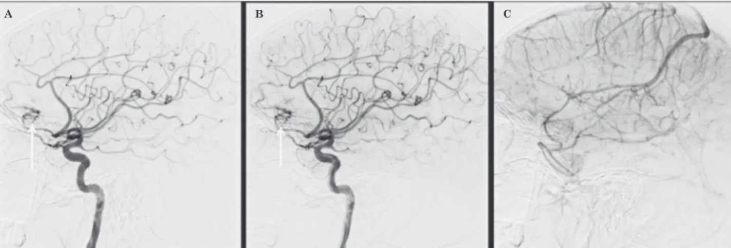 Figure 4  Cerebral angiography. Lateral projection of right internal carotid artery injection showing the abnormal vasculature (ar- (ar-rows) (A,B)
