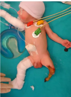 Figure 1 Postaxial polydactyly with an attached necrotic soft tissue mass.
