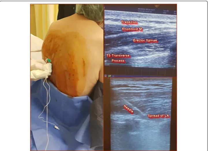 Fig. 1 a Block preparation. b Sonographic anatomy. c Spread of local anesthetic (below erector spinae muscle, above the transverse process)