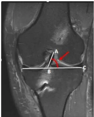 Fig. 1 The sagittal ACL graft angle was described as the angle between the midline of the sagittal plane anterior cruciate ligament graft (AB) and the reference line perpendicular to the tibial shaft (BC).