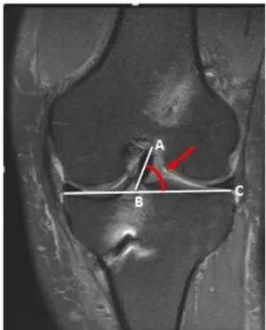 Fig. 1 The sagittal ACL graft angle was described as the angle between the midline of the sagittal plane anterior cruciate ligament graft (AB) and the reference line perpendicular to the tibial shaft (BC).