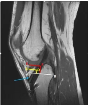 Fig. 5 Femoral tunnel clock position measurement on the axial-cut MRI scan of the right knee
